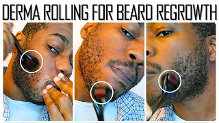 Microneedling for Beard Growth  30 Day Results [upl. by Junna]