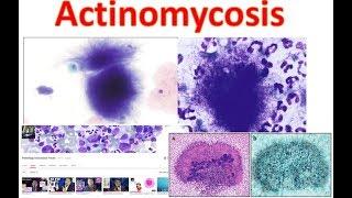 Actinomycosis Medschooltutorial [upl. by Nath]