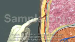 Thoracotomy  Normal Procedure [upl. by Ybroc]