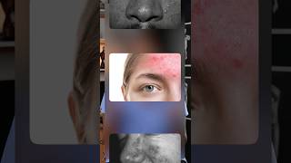 Acne Rosacea Explained acne rosacea [upl. by Landry176]