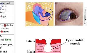 USMLE ACE Video 25 Collagen Synthesis and Disorders Types IIV and FibrillinRelated Conditions [upl. by Eisdnil]