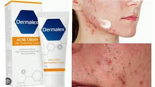 Dermalex Acne Treatment Cream [upl. by Mylan102]