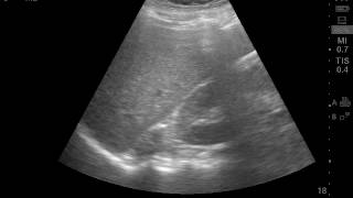 Right adrenal gland tumor [upl. by Silirama]