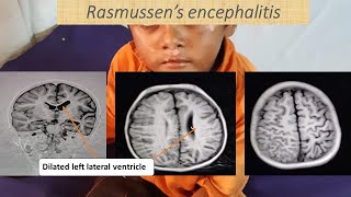 A case of Rasmussen’s Encephalitis  Pediatrics [upl. by Greiner]