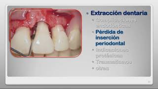 RTR Preservación del Reborde Alveolar Post Extracción [upl. by Imij]