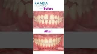 Bimaxillary protrusion  open bite and diastema [upl. by Atnuahc]