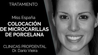 Carillas de Porcelana de la Miss España para Miss Universo [upl. by Atenik]