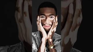 How does vitiligo occur सफेद दाग shorts facts vitíligo science medical viralvideo trending [upl. by Bruis]