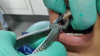 Painless and Easiest method for tooth extraction [upl. by Crosby]