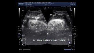 Bilateral Renal Parenchymal Disease Two videos [upl. by Treb614]