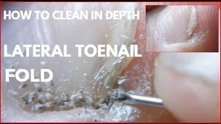 How to clean in depth lateral toenail fold 3 [upl. by Oringas]