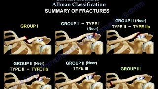 Clavicle Fractures Classification  Everything You Need To Know  Dr Nabil Ebraheim [upl. by Esom239]