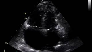 Severe Mitral Regurgitation and Normal LV Size [upl. by True]