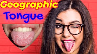 Benign Migratory Glossitis😛  Geographic👅 Tongue Homeopathic Treatment  Mapped Tongue 😜 [upl. by Fenn]