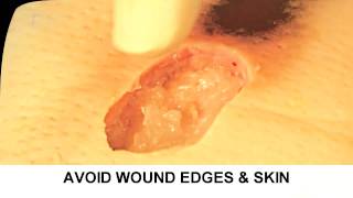 Enzymatic Debridement Demonstration Understand Wound Care [upl. by Vanden]