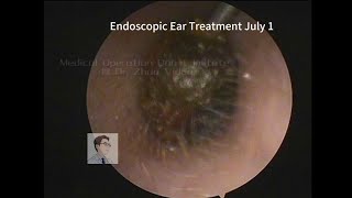 Ear wax removal CERUMEN cleaning 🧹 20230701 [upl. by Ardnikal]