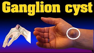 ganglion cyst [upl. by Neliak]