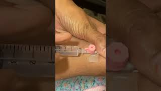 IV cannula insertiondoctertrendingforyoulovestatusshortvideoviralvideo [upl. by Mala]