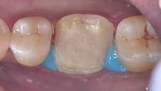 Root canal treatment followed by preliminary overlay preparation A detailed video [upl. by Kendy]