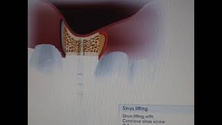 Sinus lift video using MISImplants Bone compression kit [upl. by Lurleen]