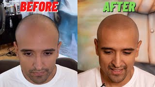 INCREDIBLE Scalp Micropigmentation Transformation [upl. by Heddi]