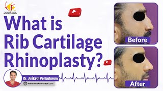 Using Rib Cartilage for Augmentation Rhinoplasty  Is it safe Venkat Center Bangalore [upl. by Emyaj]