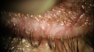 Extracting Dead Demodex Mite Carcasses from Eyelid [upl. by Teeniv]