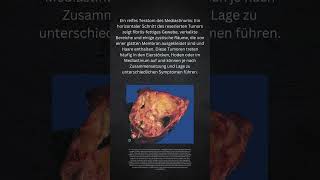 Wie kommt es zu sowasTeratom Medizin Tumor Pathologie Onkologie Mediastinum Selten [upl. by Andri315]