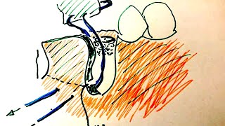 Suturing a membrane to the periostium for a one wall defect bone graft around dental implant [upl. by Sholley]