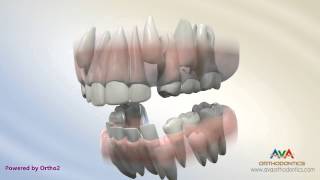 Orthodontic Treatment for Severe Crowding  Serial Extraction [upl. by Rodd]