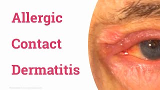 Allergic Contact Dermatitis of Eyelid [upl. by Marjorie]