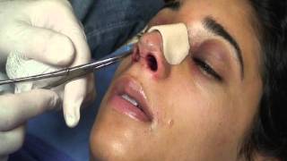 The Kotler Nasal Airway  Removal of the Airway [upl. by Deland916]