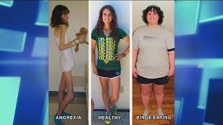 How an Anorexic Can Become a Binge Eater [upl. by Quin]