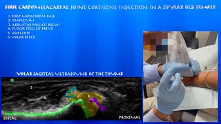 Ultrasound Guided Carpometacarpal Joint Injection in a 59 Year Old Female by probeultrasound [upl. by Timrek833]