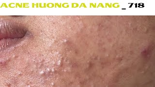 Acne Treatment Huong Da Nang 718  Remove Blackheads [upl. by Arratoon661]