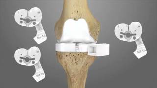 iTotal CR Total Knee Replacement Surgical Technique Animation  Conformis [upl. by Nork]