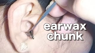 Girls Earwax Chunk Removal [upl. by Prudy]