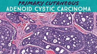 Adenoid cystic carcinoma of skin AIP France 2021  bonus case dermpath dermatology pathology [upl. by Ttej461]