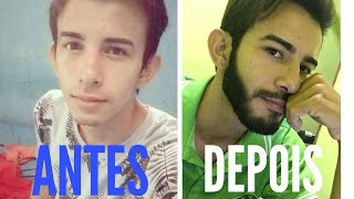 Antes e depois minoxidil na barba Minoxidil beard before and after [upl. by Cyb389]