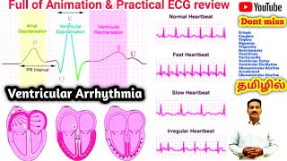 Ventricular Arrhythmia in tamil  couplet triplets flutter Fibrillation bigeminy trigeminy [upl. by Rillis]