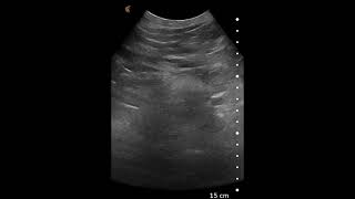 Abdominal Aortic Aneurysm AAA  Ultrasound Image Interpretation [upl. by Lucienne]