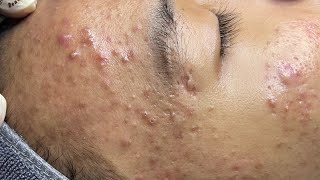 ACNE TREATMENT VU QUYNH MI  Perennial Blackheads On Boy Face 2024FULL [upl. by Sad]