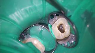 simplified root canal treatment total procedure [upl. by Thordia128]