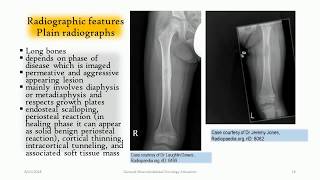 LangerhansCell Histiocytosis of the bone  ‘‘The great mimmicker’’ [upl. by Ainegul507]