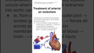 Treatment of arterial air embolism [upl. by Samaj229]