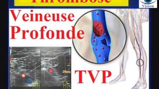 Thrombose veineuse profonde symptômes traitement recommandations Prévention de lembolie pulmonaire [upl. by Mehsah907]