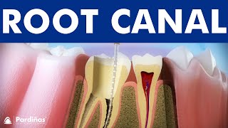 ROOT CANAL treatment step by step  3D video of endodontics for tooth decay © [upl. by Lanod326]