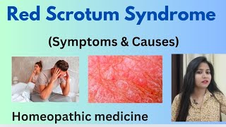 Red Scrotum Syndrome treatment  Red Scrotum Syndrome RSS symptomscauses amp homeopathic medicine [upl. by Prevot993]