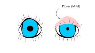 Apraclonidine Test  Horners Syndrome [upl. by Naji90]