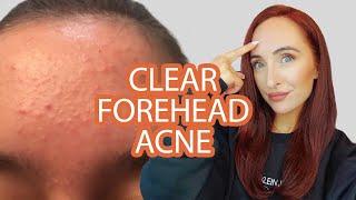 HOW TO GET RID OF FOREHEAD ACNE  NATUROPATHIC NUTRITIONIST TIPS [upl. by Vastah]